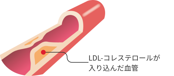 LDL-コレステロールが入り込んだ血管
